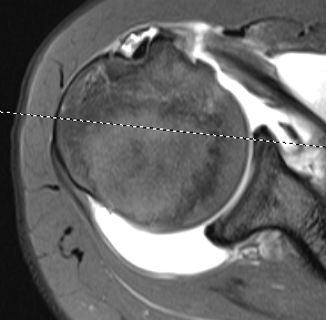 Subscapularis Tear MRI